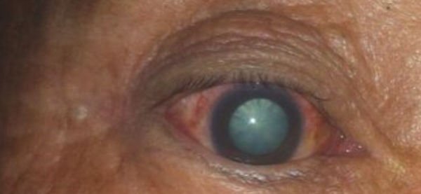 青光眼有些什么症状