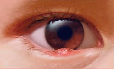 眼睑炎有些什么症状